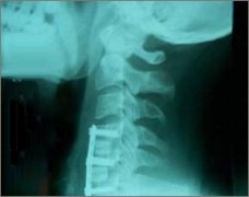 颈椎间盘突出的科学诊断方法